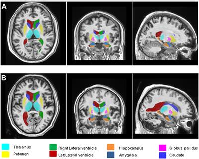 Cerebellar Abnormalities on Proton MR Spectroscopy and Imaging in Patients With Gluten Ataxia: A Pilot Study